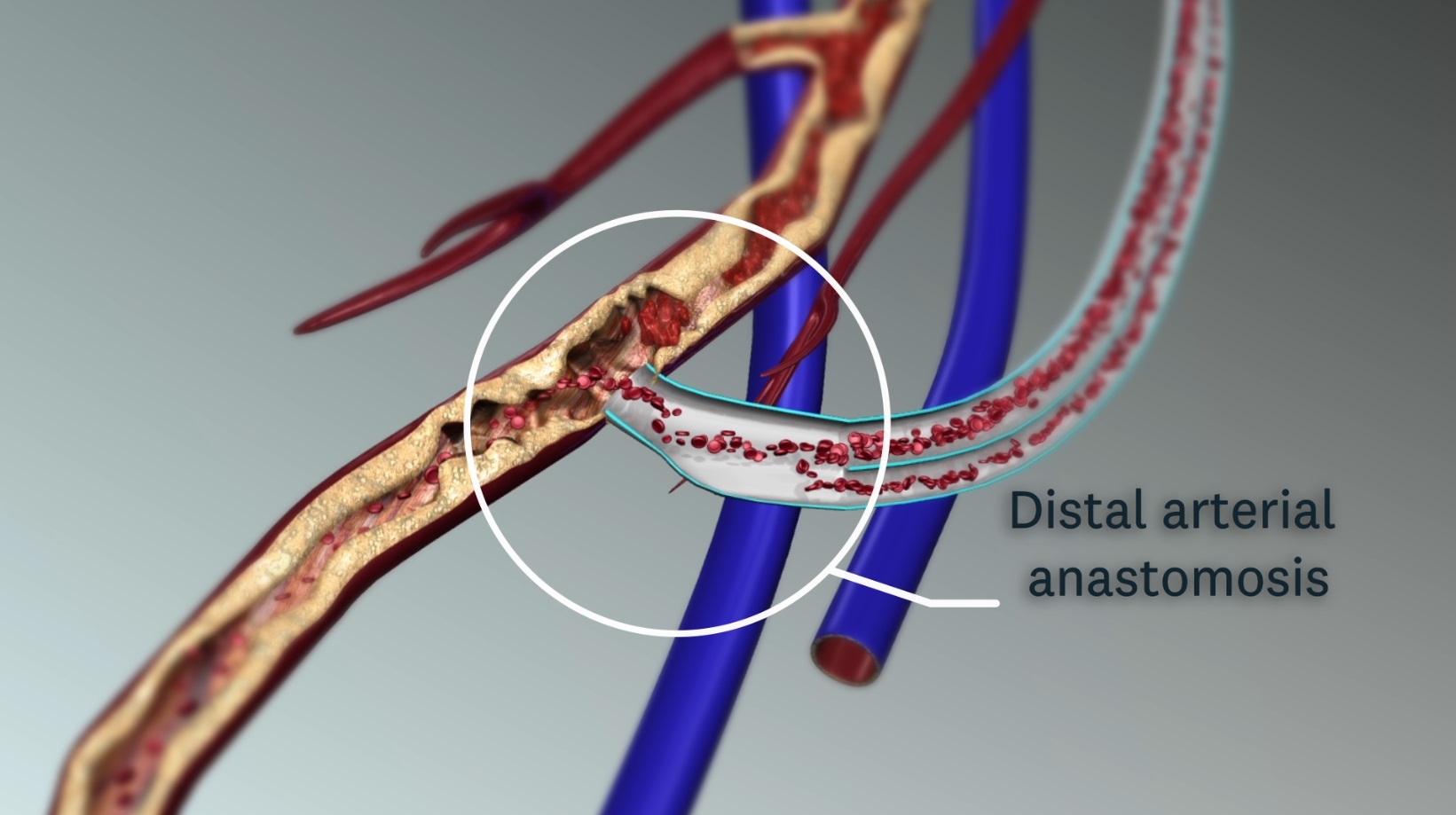 Diagram of the distal arterial anastomosis of the bypass graft