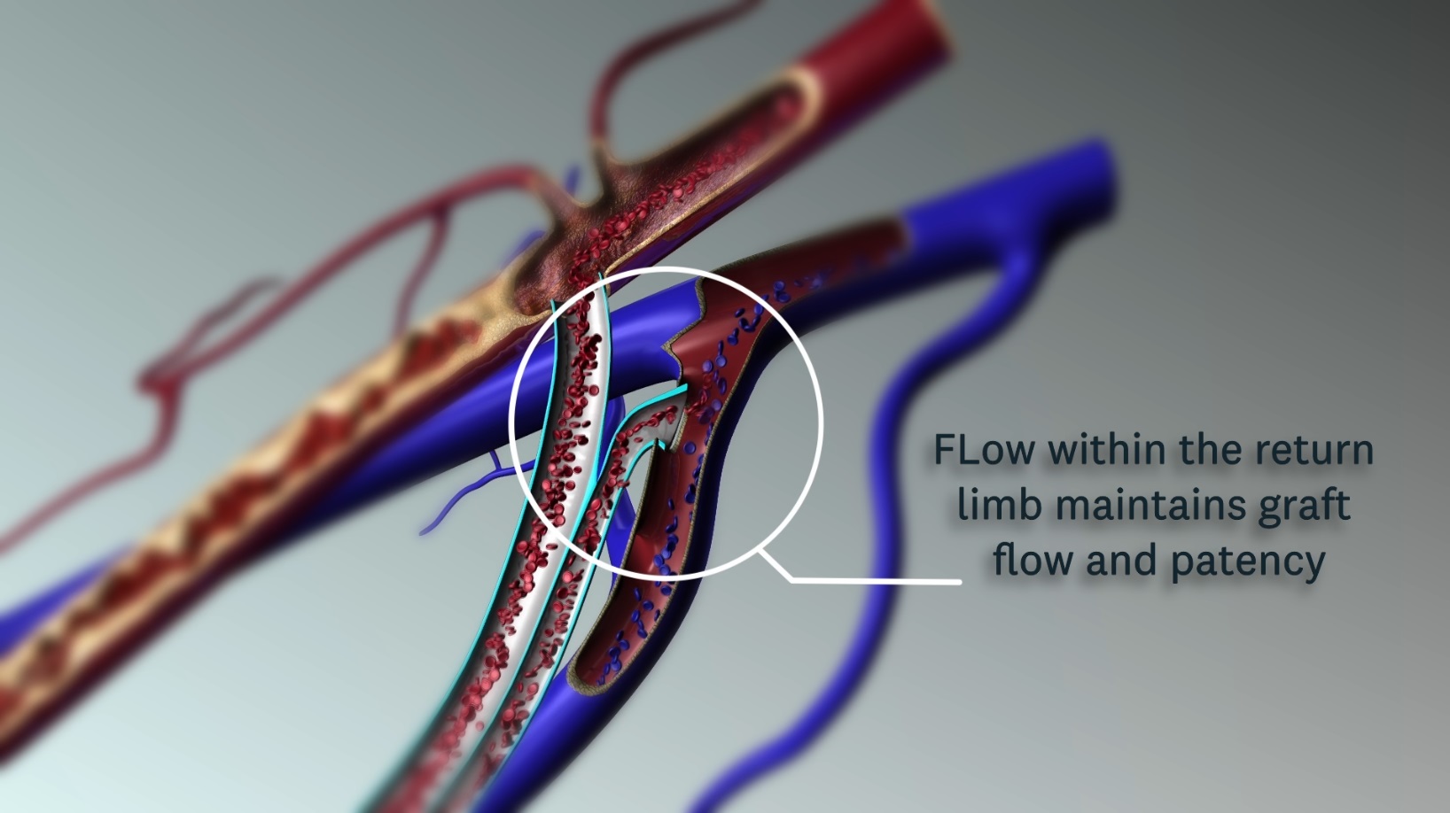 Diagram of the proximal venous return limb of the bypass graft