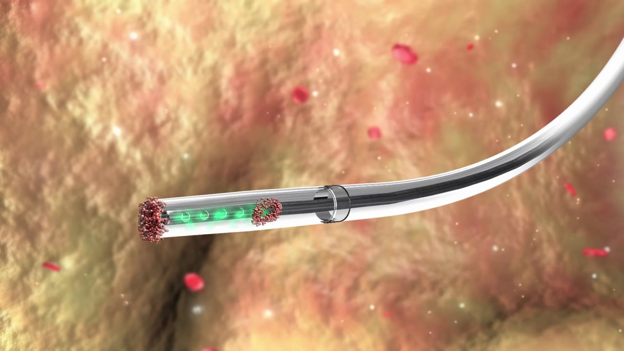 Catheter clearance device